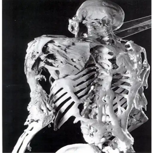 historic skeleton of Harry Eastlack