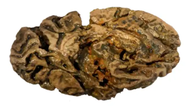 brain from an individual buried in a waterlogged Victorian workhouse cemetery