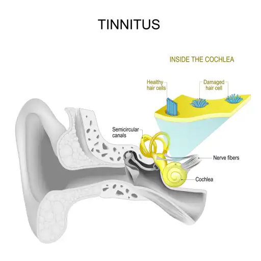 cochlea inside the inner ear can generate subjective low-frequency tinnitus signals